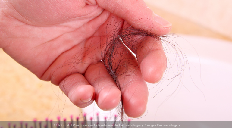 Alopecia o calvicie