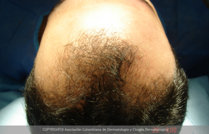Alopecia