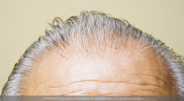 Alopecia