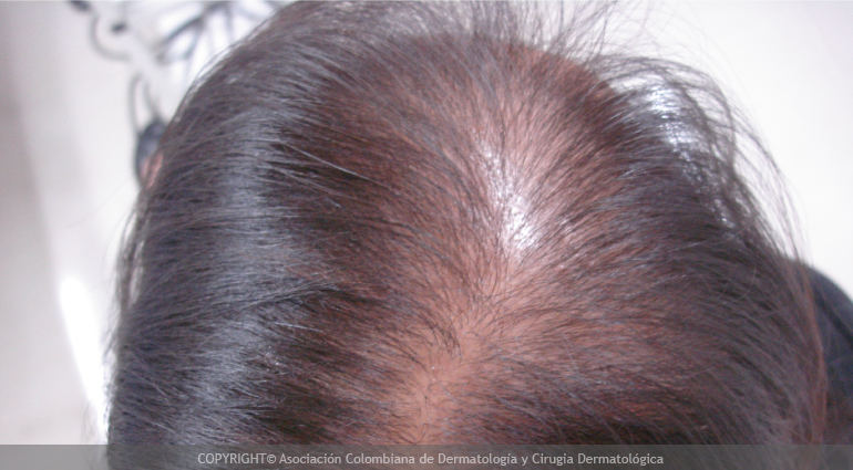 Alopecia
