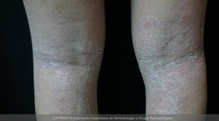 Dermatitis atópica