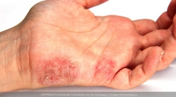 Psoriasis