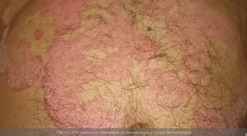 Psoriasis