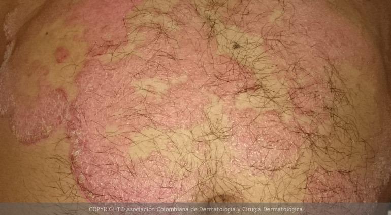 Psoriasis