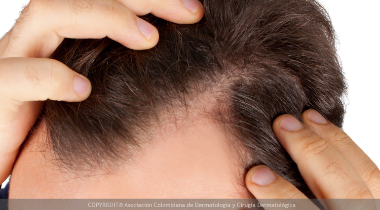 Alopecia O Calvicie Enfermedades Dermatológicas Asocolderma 4037