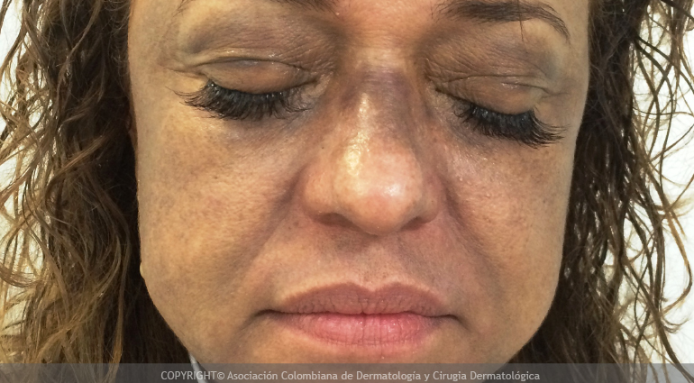 Dermatitis cenicienta