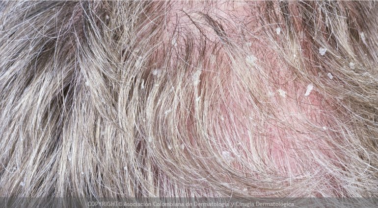 Dermatitis seborreica (Caspa)