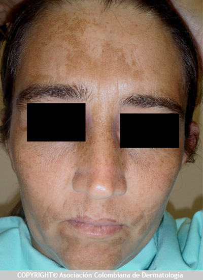 Melasma o Cloasma (manchas oscuras en la cara) AsoColDerma