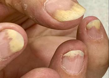 Psoriasis