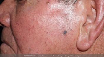 nevus azul