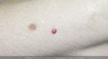 nevus rubi