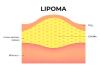 Lipoma