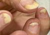 Psoriasis