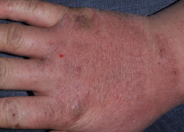 dermatitis de contacto