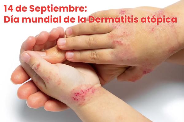 Norit - Hoy es el día mundial de la Dermatitis atópica, un trastorno que  provoca el enrojecimiento de la piel y picazón🔥. Aunque por supuesto lo  que te recomendamos es que vayas