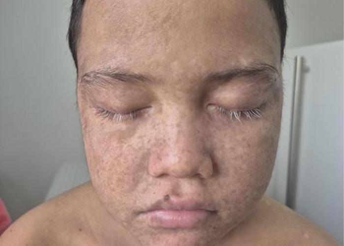 CASO #316: Despigmentación progresiva postrasplante, evaluación del caso